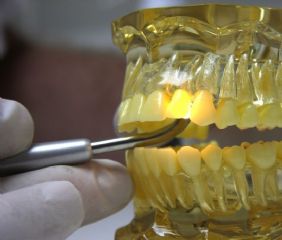zähne aufhellen beim zahnarzt